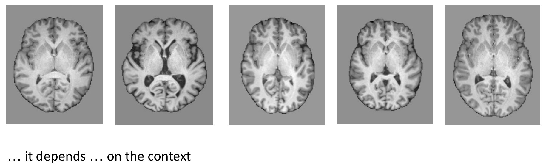 Five similar-looking brain MRI slices, one of which differs subtly with age-related changes