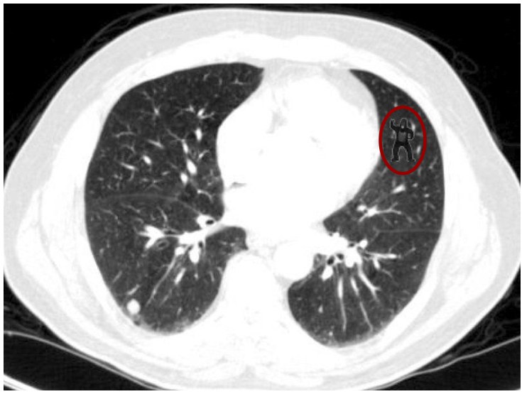 Axial lung CT with a small gorilla figure rendered inside the right lung, circled in red
