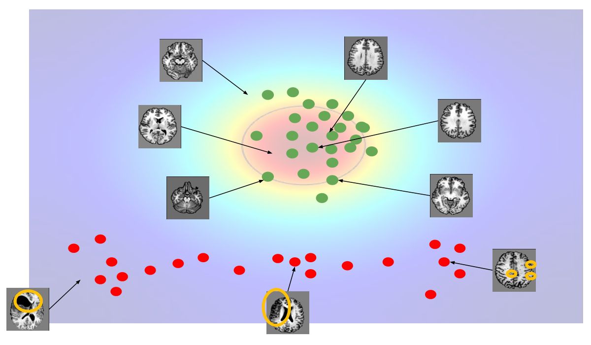 The same 2D anomaly detection picture, but with brain MRI slices as data points arranged along a normal-abnormal spectrum