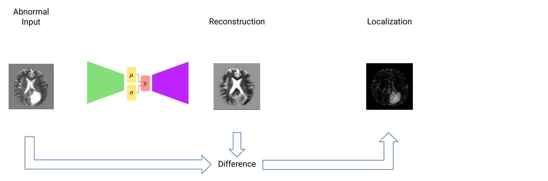 An abnormal brain MRI is encoded and reconstructed by a VAE; the difference between input and reconstruction is used for anomaly localization