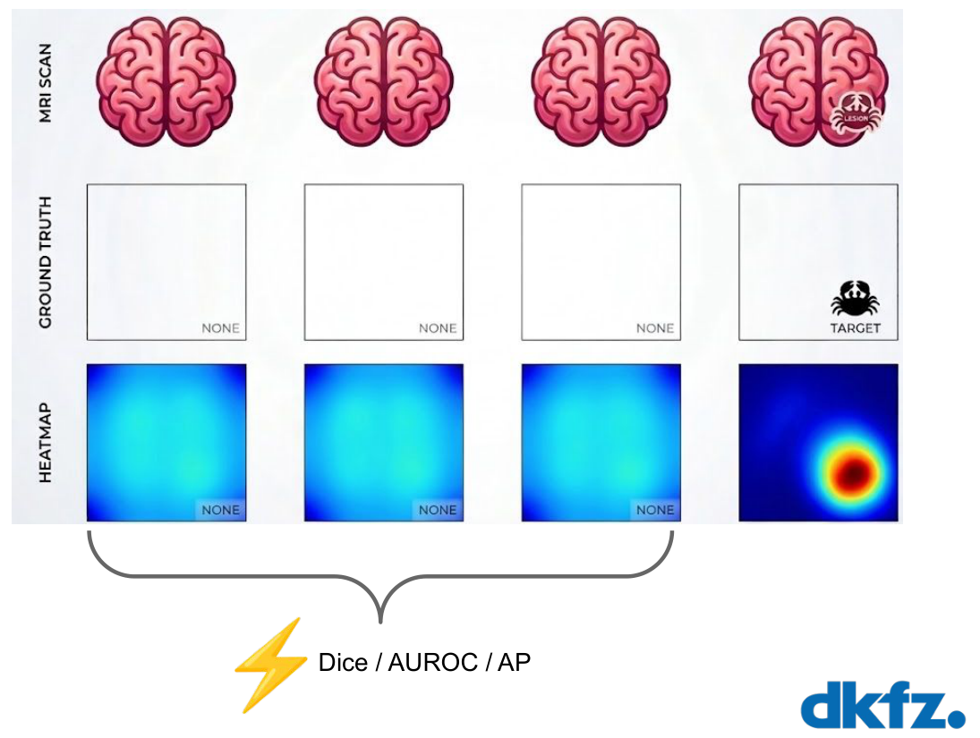 Three normal scans with NONE ground truth and near-uniform heatmaps, demonstrating that Dice, AUROC and AP are undefined or unstable for such samples