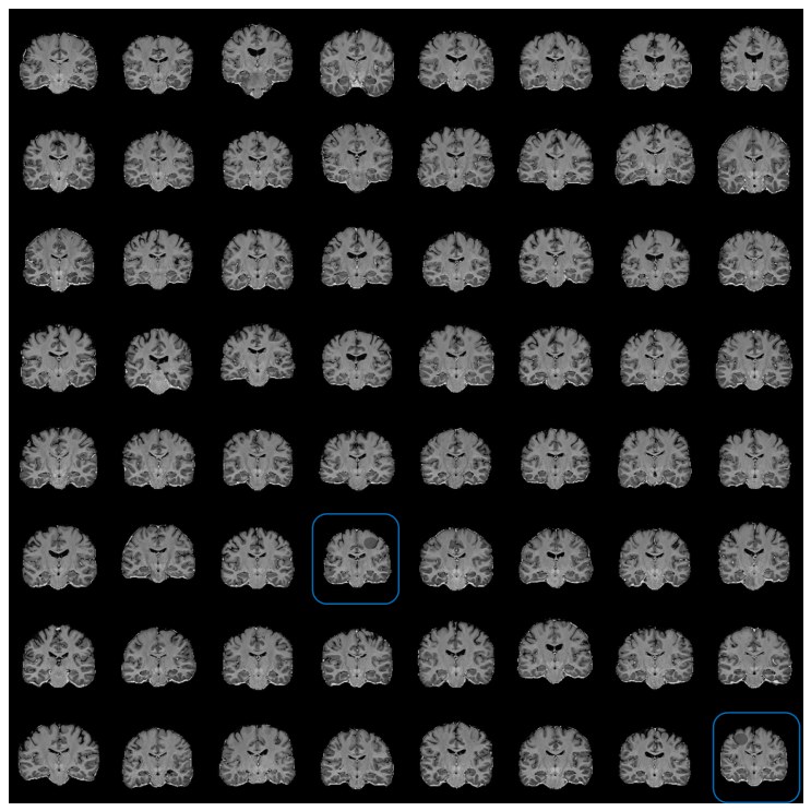 A dense grid of brain MRI slices with two tiny highlighted anomalies