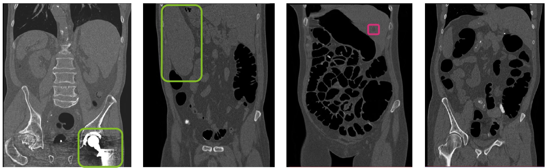 Four abdominal CT slices with a large implant and an enlarged spleen highlighted in green, a small liver lesion highlighted in pink, and one unmarked scan