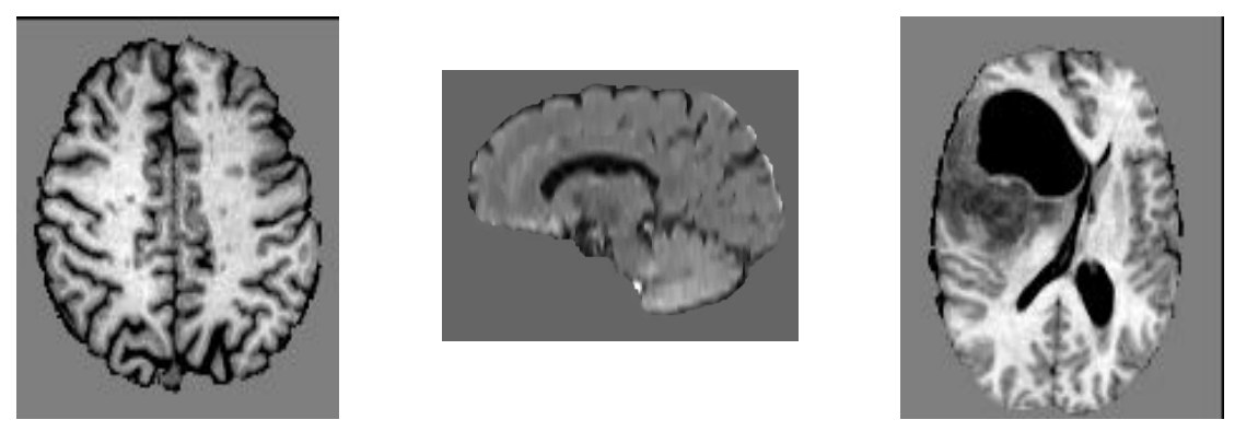 Three brain MRI slices: normal axial, normal sagittal, and one with a large dark abnormality