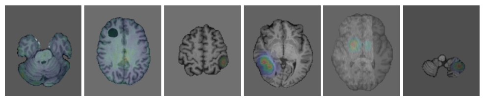 Six brain MRIs with colored anomaly heatmaps overlaid: two missed findings, two detected reported findings, two detected but previously unreported anomalies